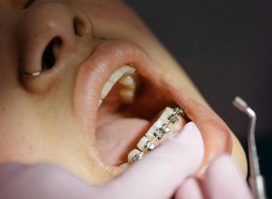 por-que-os-dentes-voltam-a-entortar-apos-o-uso-de-aparelho-ortodontico