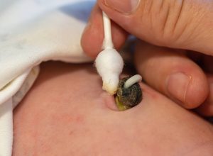 os-riscos-de-guardar-e-consumir-tecido-humano,-como-cordoes-umbilicais